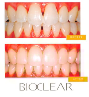 bioclear-before-and-after