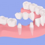 Dental Bridges