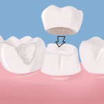 Dental Crowns