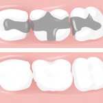 Dental Fillings Dental Fillings