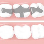 Dental Fillings