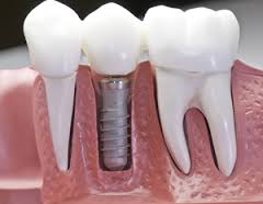 Implant Crowns