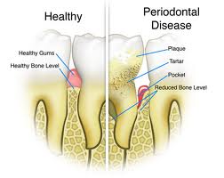 Periodontal Disease