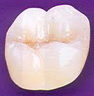 Porcelain Crowns