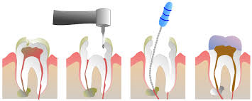 Root Canals