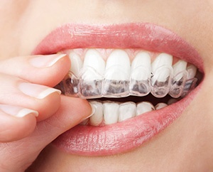 Teeth Whitening Tray